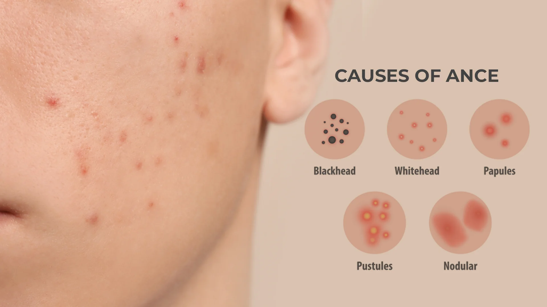 Acne Causes Image 2